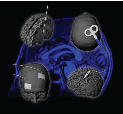 Neuromodulation Technologies for Brain Disorders