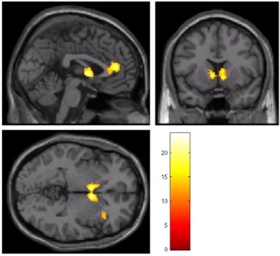 fMRI Scan of Smoker's Brain